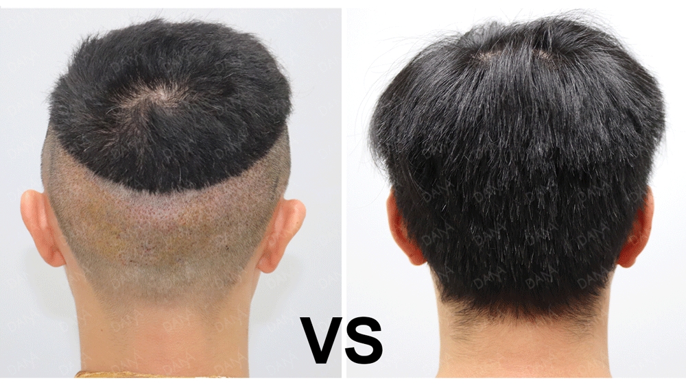 取髮區剃頭FUE及免剃頭FUE術後第一天比較。