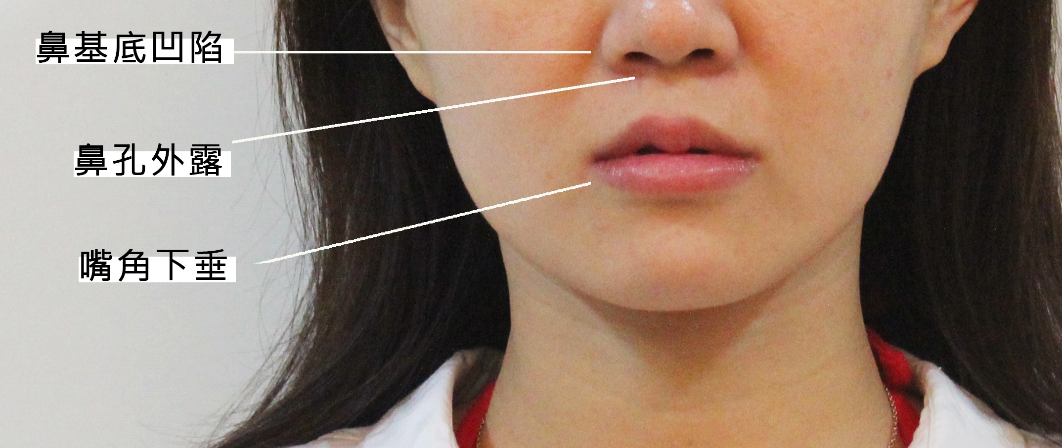 ▲除了老化所造成的法令紋，典型的亞洲人輪廓，常有中臉比較平、鼻唇溝凹陷等特徵，因此法令紋明顯，甚至合併鼻孔外露。