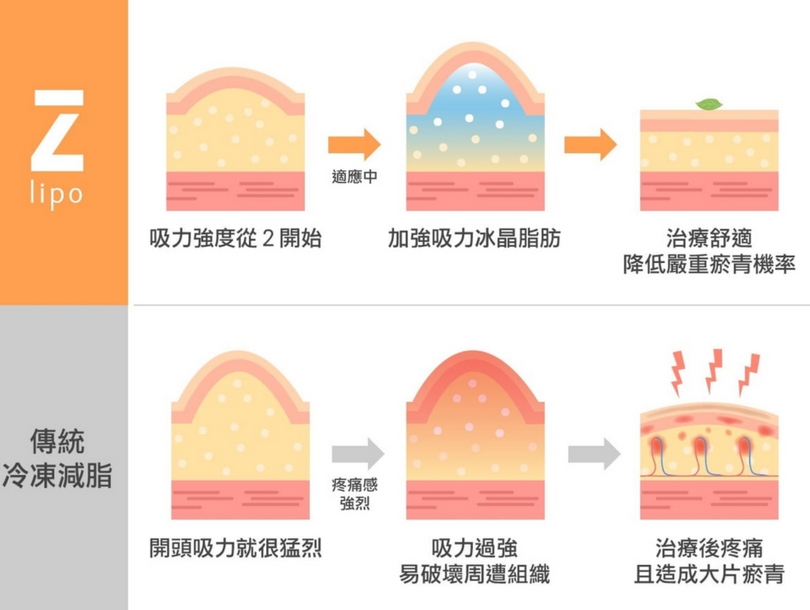 傳統冷凍減脂與Z lipo Z塑酷差異（圖片來源出自Zimmer）