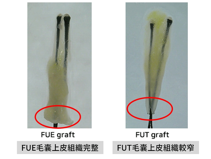 Reference: A Practical Guide to Hair Graft Placement Using the Sharp Implanter Method ; Clin Cosmet Investig Dermatol. 2023; 16: 1777–1785.