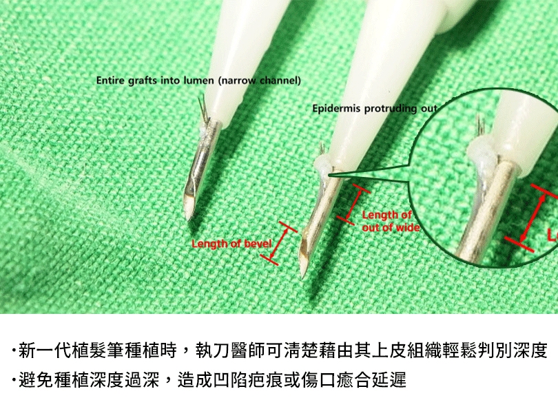 Reference: A Practical Guide to Hair Graft Placement Using the Sharp Implanter Method ; Clin Cosmet Investig Dermatol. 2023; 16: 1777–1785.