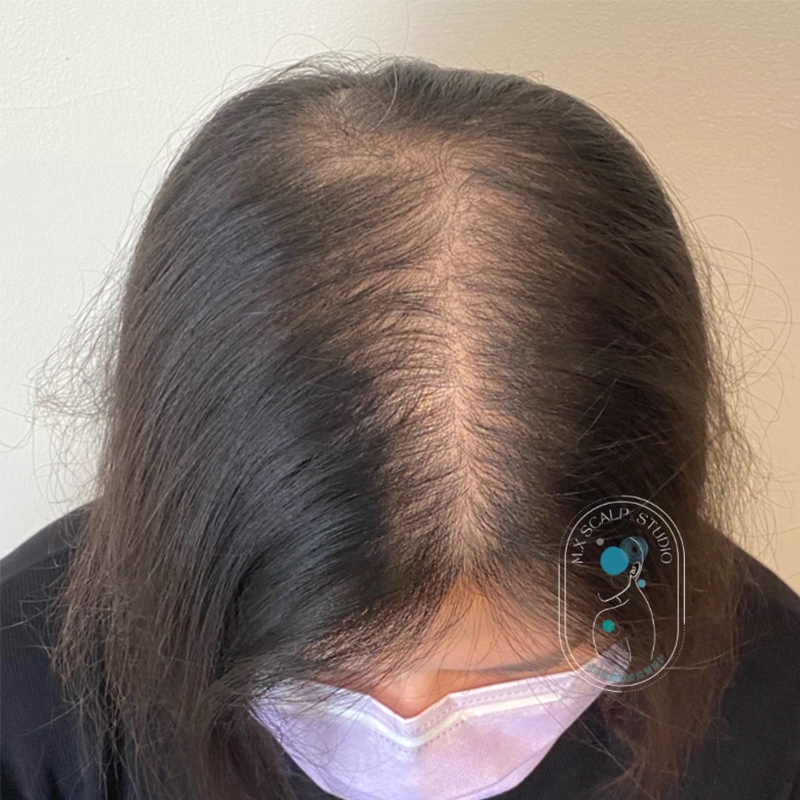 遺傳性落髮施作KSMP紋髮技術前