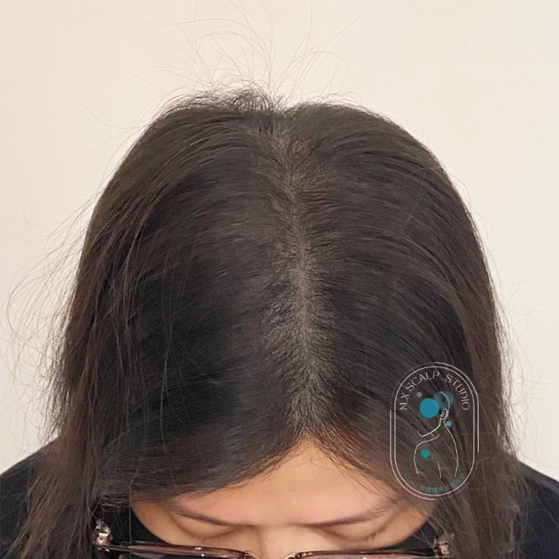 遺傳性落髮施作KSMP紋髮技術後