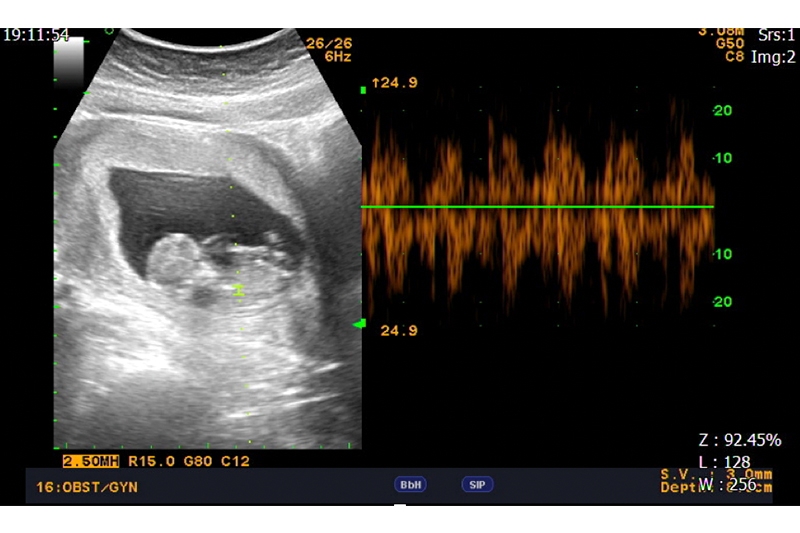 成功案例胎兒超音波影像，圖片由暖心陪孕-李宗賢醫生提供