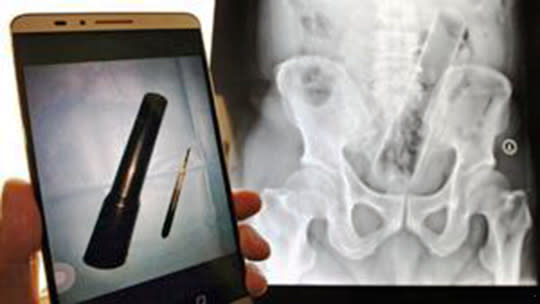 This Man Needed Surgery To Remove 10-Inch Torch Which Got Stuck Somewhere Very Painful