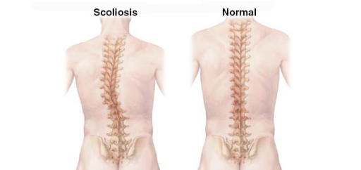 Scoliosis Bisa Sembuh dengan Latihan Ini?