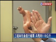 三姐妹縮胃手術 共甩肉118公斤