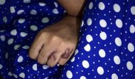 Mão de jovem indiana atacada com ácido