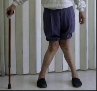 人老了，膝蓋痛，根據統計顯示，60歲以上的族群，高達8成有退化性關節炎，但骨科醫師門診觀察發現，不少老人家怕手術，往往一忍就是5、6年，長年忍痛，忍到關節嚴重變形，甚至撐出X型腿、O型腿，原本還能拄著柺杖走路，最後連站都站不起來。