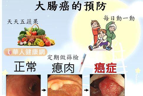 病患若檢查發現具有大腸息肉，應更加小心。（圖片提供／亞東醫院）