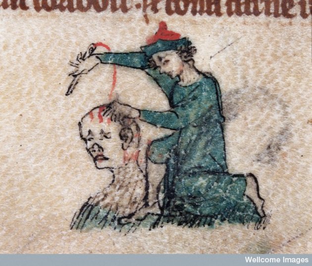 Trepanning