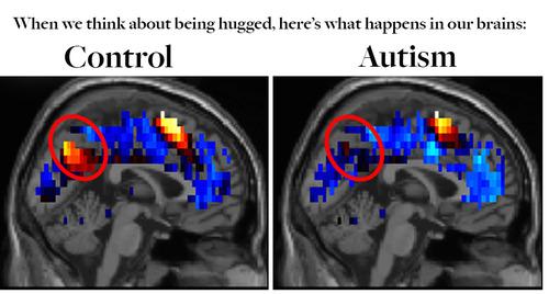 News in Autism and Related Disorders - Page 2 4692767b0954cb2d6d280294f78380fdf0f3aad8