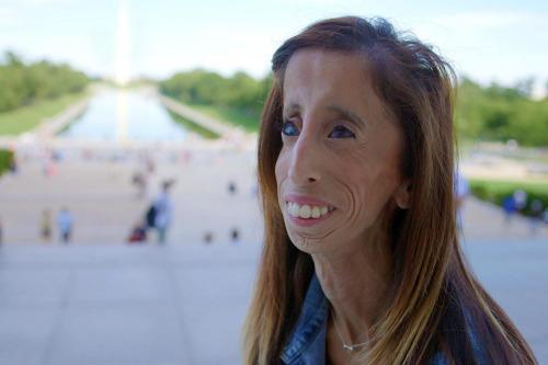 Teen Called 'World's Ugliest Woman,' Now Grown Up, Starring in New Documentary