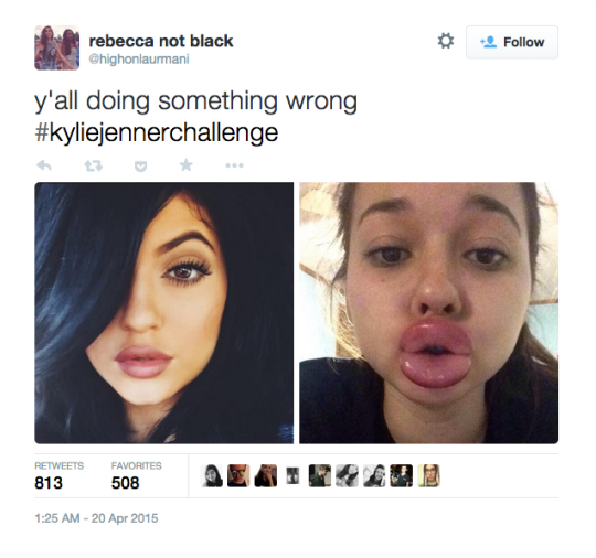 #KylieJennerChallenge DIY Beauty Trick Produces Terrifying Results