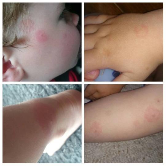 Bullseye rash on child diagnoses him with Lyme disease