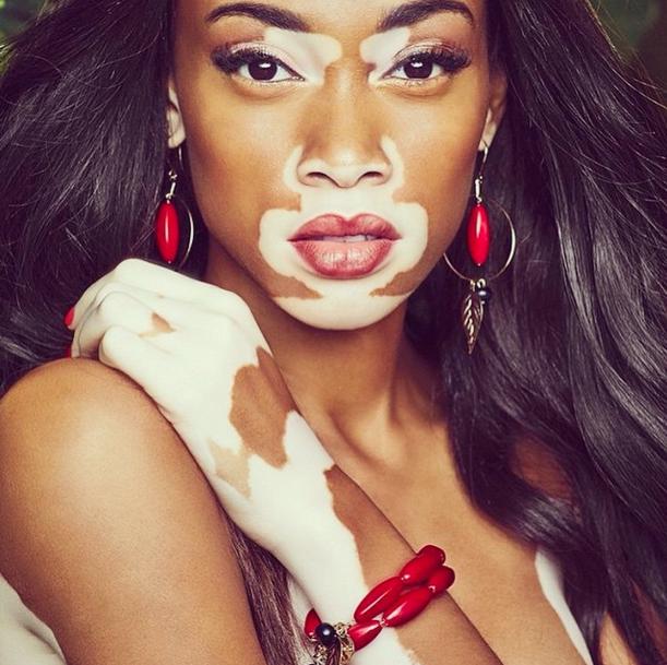 What causes vitiligo? - Quora