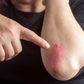 What Causes Plaque Psoriasis?