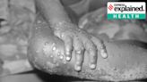 Why Congo’s latest Mpox outbreak is concerning