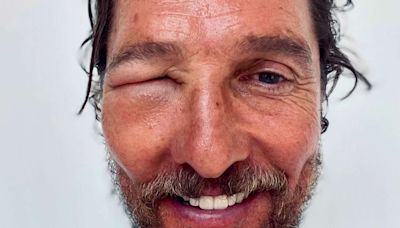 Matthew McConaughey Shocks Fans with His Swollen Eye: 'Bee Swell'