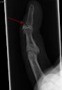 Avulsion fracture