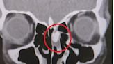 頭痛5年原來它作怪！醫揭6旬婦鼻竇藏1公分鼻屎、竟讓她痛到眼睛快炸出來