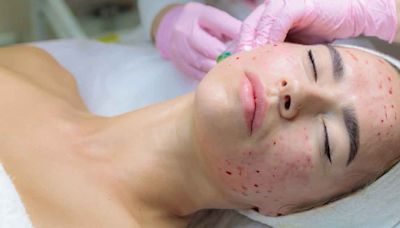 Tres mujeres contraen VIH tras someterse a extraño tratamiento de belleza 'vampiro facial'