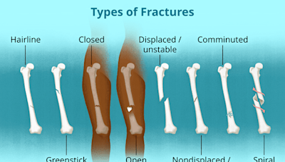 Fracture: What to Know About This Injury