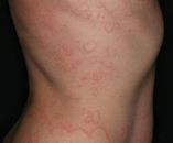 Chronic spontaneous urticaria