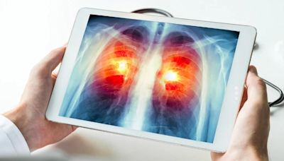 Cáncer de pulmón: cómo funciona la nueva inmunoterapia aprobada por la Anmat que busca prevenir las recaídas
