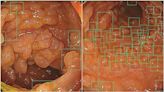 密集恐懼症慎入！AI大腸鏡一照「密密麻麻全是息肉」 醫護嚇到直接尖叫