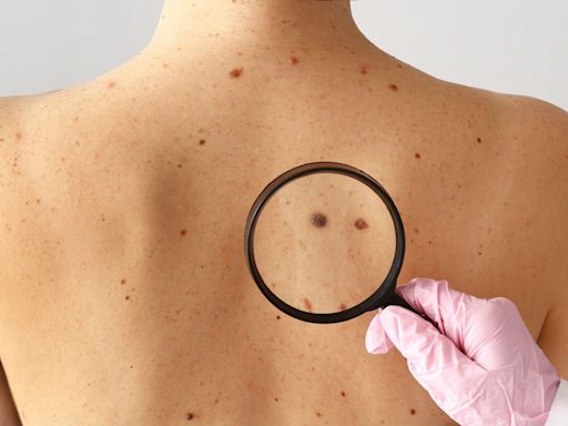 Cirugía de MOHS: el tratamiento para el cáncer de piel que tiene mayor tasa de curación y pocos lugares realizan