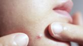 What's in a zit? How pimples form and what different acne types are made of
