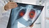 Most lung cancer patients in India non-smokers, decade younger than those in West: Lancet studyg - CNBC TV18