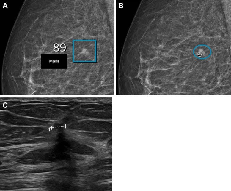 Fewer False Positives: AI Transforms Breast Cancer Screenings With Sharper Accuracy