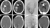 Study investigates acute pseudoaneurysms following head gunshot wounds