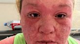 'My hair, nails and skin fell off after mosquito bite on holiday'