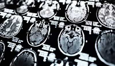 How MRI scans can help with Parkinson's disease diagnosis, treatments