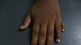 The Genetics Behind Why 6 Fingers Per Hand, Not 5, Is the Dominant Trait