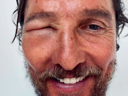 Matthew McConaughey Shares Photo of Bee Sting That Made His Eye Swell Shut