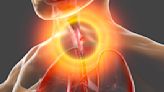 Do you know the symptoms of esophageal cancer? - WTOP News