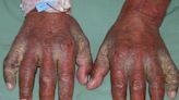 Scabies Pictures: What It Looks Like