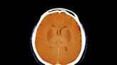 Unresponsive Brain-Damaged Patients May Have Some Awareness