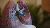 Prime Editing Corrects Cystic Fibrosis-Causing Mutation in Lung Cells