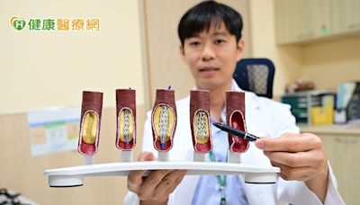 婦反覆胸痛心電圖、Ｘ光找不出異狀 「1檢查」秒見右冠狀動脈99%阻塞