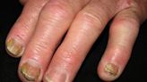 Common Types of Nail Disease: How to Spot and Treat Each