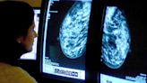 AI tool that predicts side-effect risk in breast cancer patients to be trialled