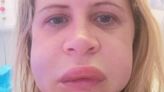 Mum 'permanently disfigured' after dentist visit sees face 'balloon'