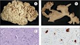 Genetic association study opens up new treatment avenues for Pick's disease, a rare form of early-onset dementia