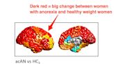 A new brain imaging study shows what anorexia does to a person's brain, and how weight gain appears to reverse the changes