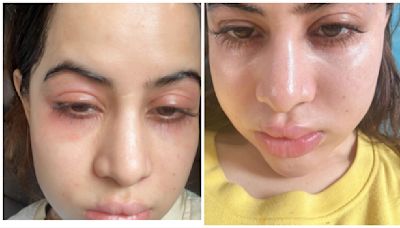 Uorfi Javed shares photos of swollen face, accepts she has been getting Botox since 18: ‘Fillers nahi hai, allergies hai’